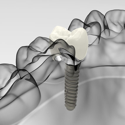 Computer rendering of a placed dental implant