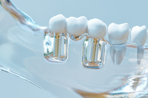 Photograph of a dental implant from Mountain State Oral and Facial Surgery 