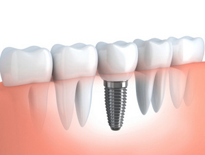 Rendering of jaw with dental implant from Mountain State Oral and Facial Surgery in Hurricane, WV Rendering of jaw with dental implant from Mountain State Oral and Facial Surgery in Hurricane, WV
