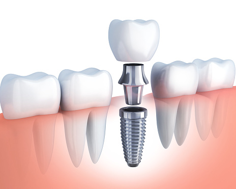 Dental implants from Mountain State Oral and Facial SurgeryHurricane, WV.