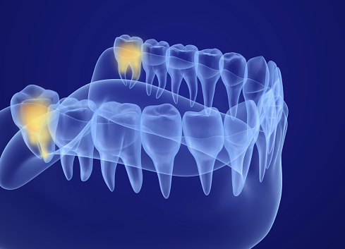 Illustration of wisdom teeth from Mountain State Oral and Facial Surgery in Charleston, WV