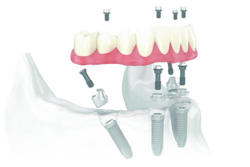 Diagram of All-on-4 Treatment Concept from Mountain State Oral and Facial Surgery in Hurricane, WV Diagram of All-on-4 Treatment Concept from Mountain State Oral and Facial Surgery in Hurricane, WV