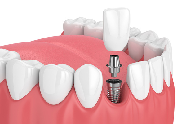 Diagram of a single dental implant Diagram of a single dental implant