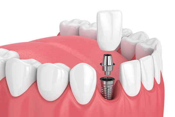 A 3D rendering of a dental implant and post A 3D rendering of a dental implant and post