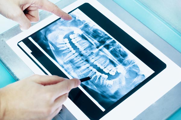 Dental x-ray of a full mouth from Mountain State Oral and Facial Surgery in Hurricane, WV