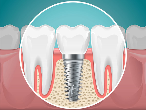 Diagram of a tooth replaced with a dental implant at Mountain State Oral and Facial Surgery in Charleston, WV