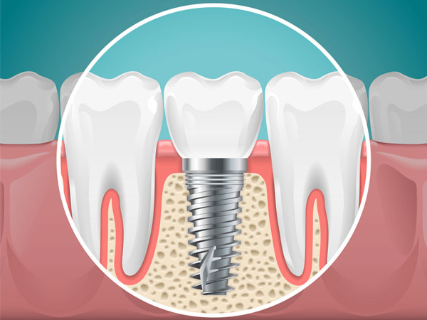 Diagram of a tooth replaced with a dental implant at Mountain State Oral and Facial Surgery in Hurricane, WV