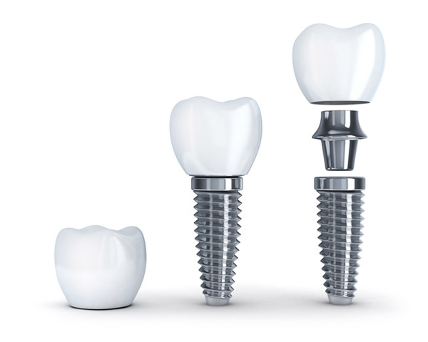 Diagram of dental implant with post from Mountain State Oral and Facial Surgery in Charleston, WV