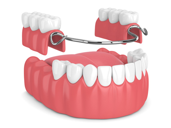 Rendering of removable partial denture from Mountain State Oral and Facial Surgery in Charleston, WV