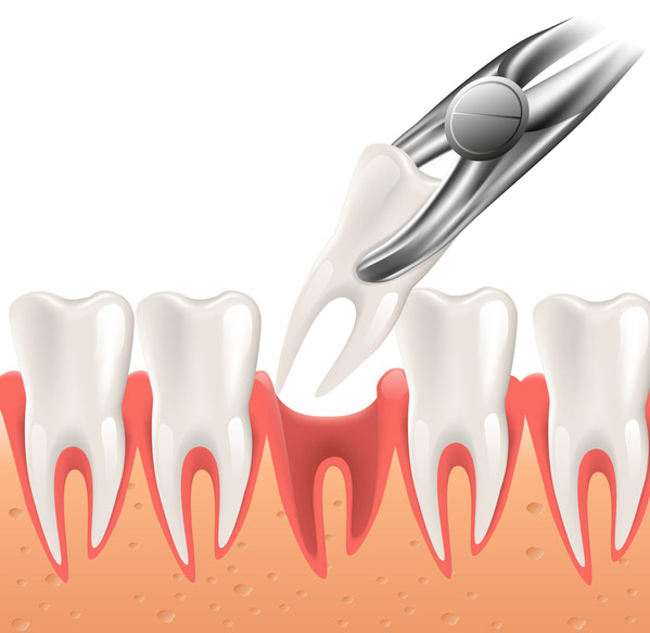 Illustration of a tooth being extracted at Mountain State Oral and Facial Surgery in Huntington, WV