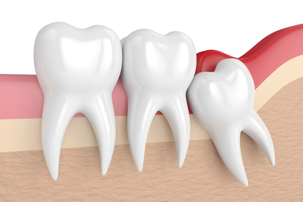 Illustration of an impacted wisdom tooth from Mountain State Oral and Facial Surgery in Vinton, VA Illustration of an impacted wisdom tooth from Mountain State Oral and Facial Surgery in Vinton, VA