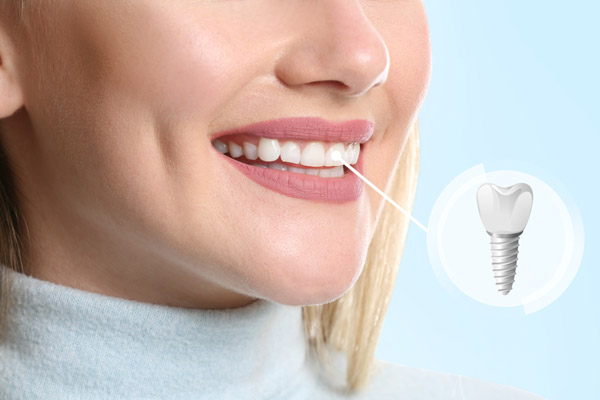 Smiling mouth with dental implants indicator at Mountain State Oral and Facial Surgery in Hurricane, WV Smiling mouth with dental implants indicator at Mountain State Oral and Facial Surgery in Hurricane, WV