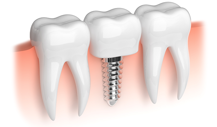 a dental implant image in Hurricane, WV