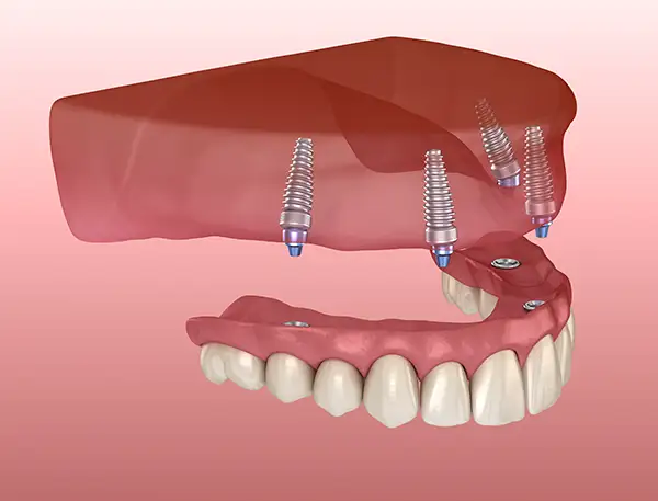 All-on-4 dental implant system with implants securing a full upper denture to the jawbone.