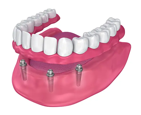 All-on-4 dental implant system in the lower jaw, showing titanium implants supporting a full dental arch.