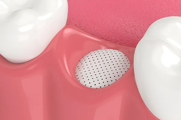 Dental bone graft covered by a protective membrane in the socket between two teeth.