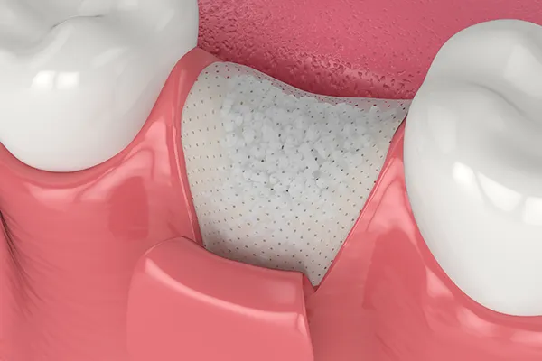 Dental bone graft in the gum, covered by a protective membrane placed between two teeth.