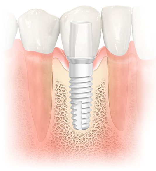 nobel pearl zirconia implants web
