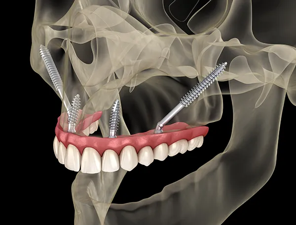 X-ray of a skull showcasing how a full arch of teeth are secured by long zygomatic implants that are placed in the cheekbones.